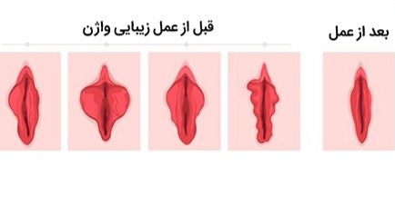 لابیا پلاستی خرم آباد