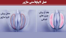 لابیا پلاستی خرم آباد
