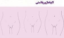 لابیا پلاستی خرم آباد
