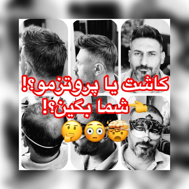 پروتز مو در فولادشهر
