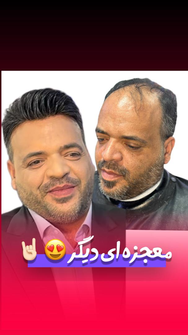 پروتز مو آرش دهقان