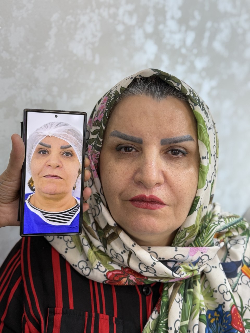 لیزر مو زائد در اصفهان