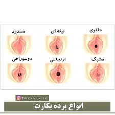 دوختن پرده بکارت در خرم اباد