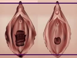 دوختن پرده بکارت در خرم اباد