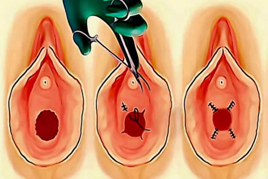 لیزر ترمیم پرده بکارت در خرم اباد