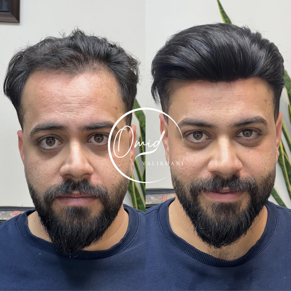 پروتز مو و ترمیم مو