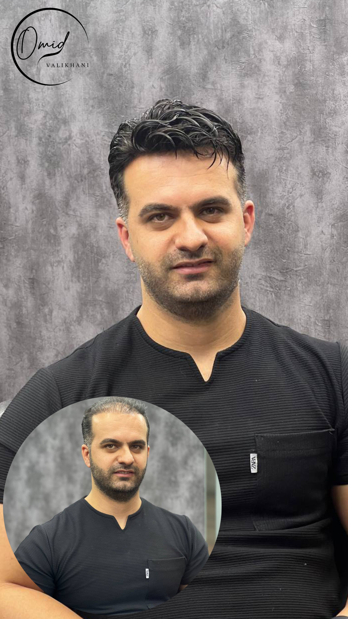 پروتز مو شاهین شهر