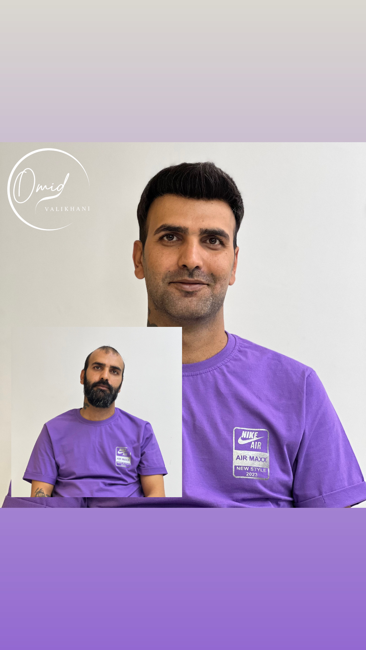 پروتز مو شاهین شهر