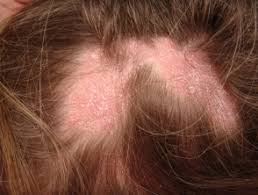 درمان قطعی لیکن پلان