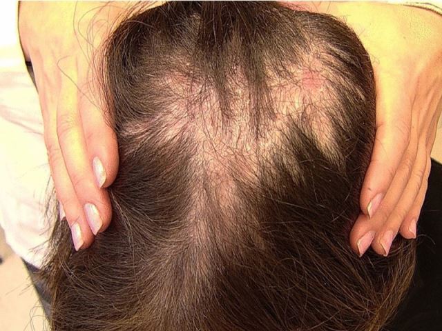 درمان بیماری لیکن پلان