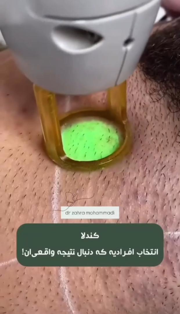 لیزر موهای زائد در دریاچه