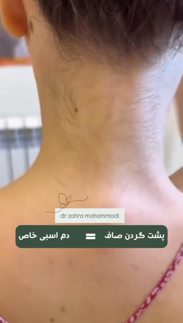 لیزر موهای زائد در دریاچه