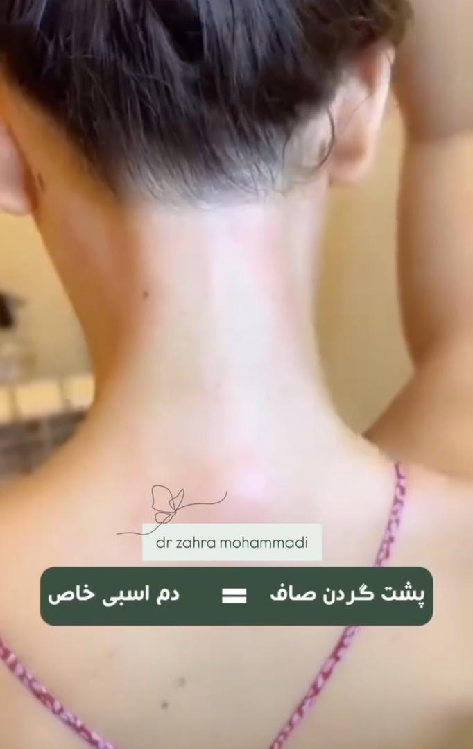 لیزر موهای زائد در دریاچه