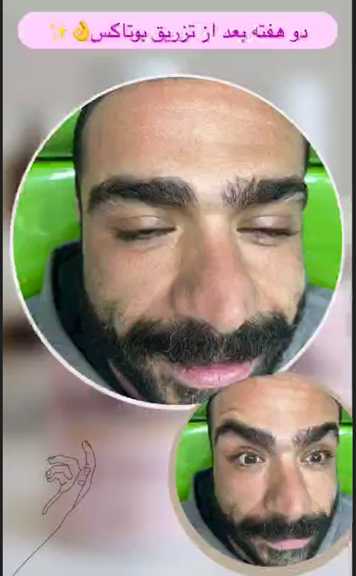 دوهفته بعد از تزریق بوتاکس