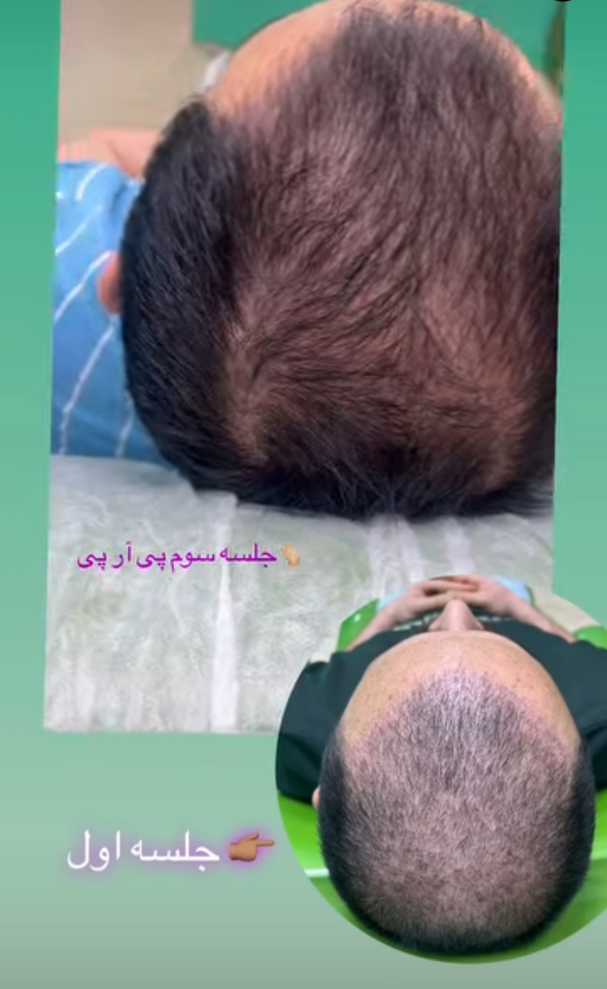 قبل و بعد از تزریق پی آر پی