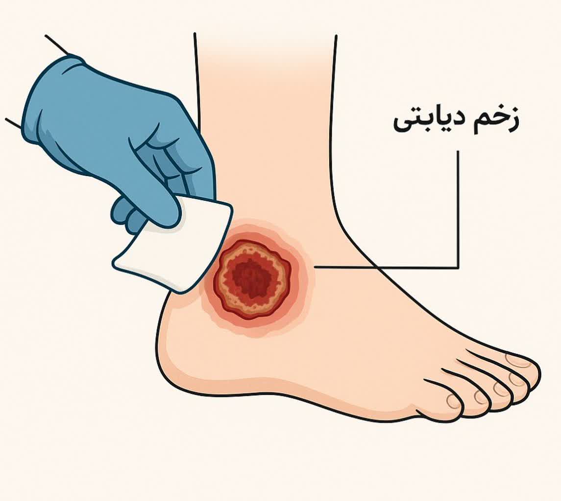 کارشناس زخم دیابت در منزل اصفهان