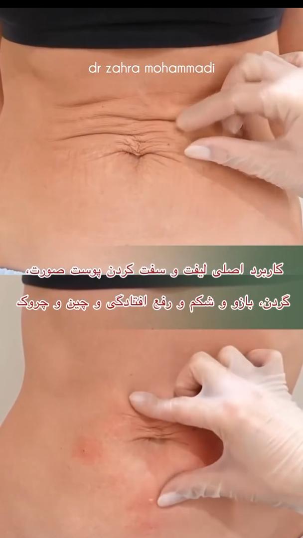 اندولیفت دکتر زهرا محمدی