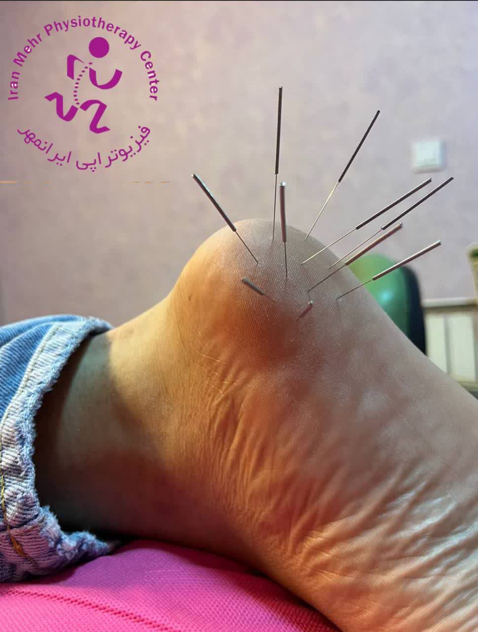 نمونه کار طب سوزنی در مهرشهر