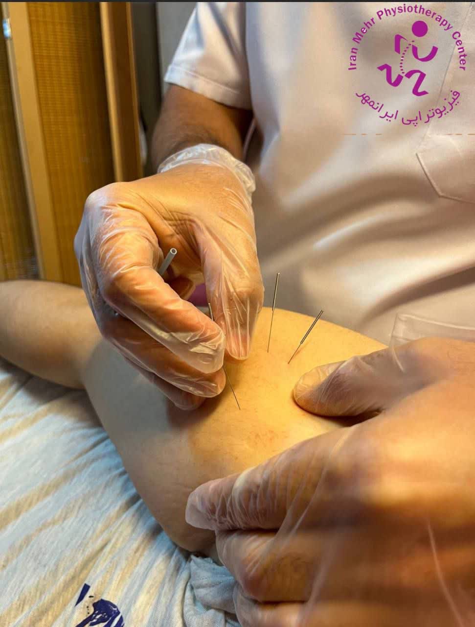 نمونه کار طب سوزنی در مرکز فیزیوتراپی ایرانمهر
