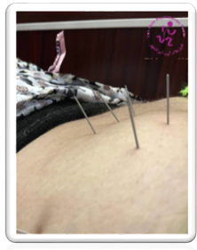 طب سوزنی ایرانمهر