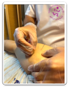 طب سوزنی مهرشهر