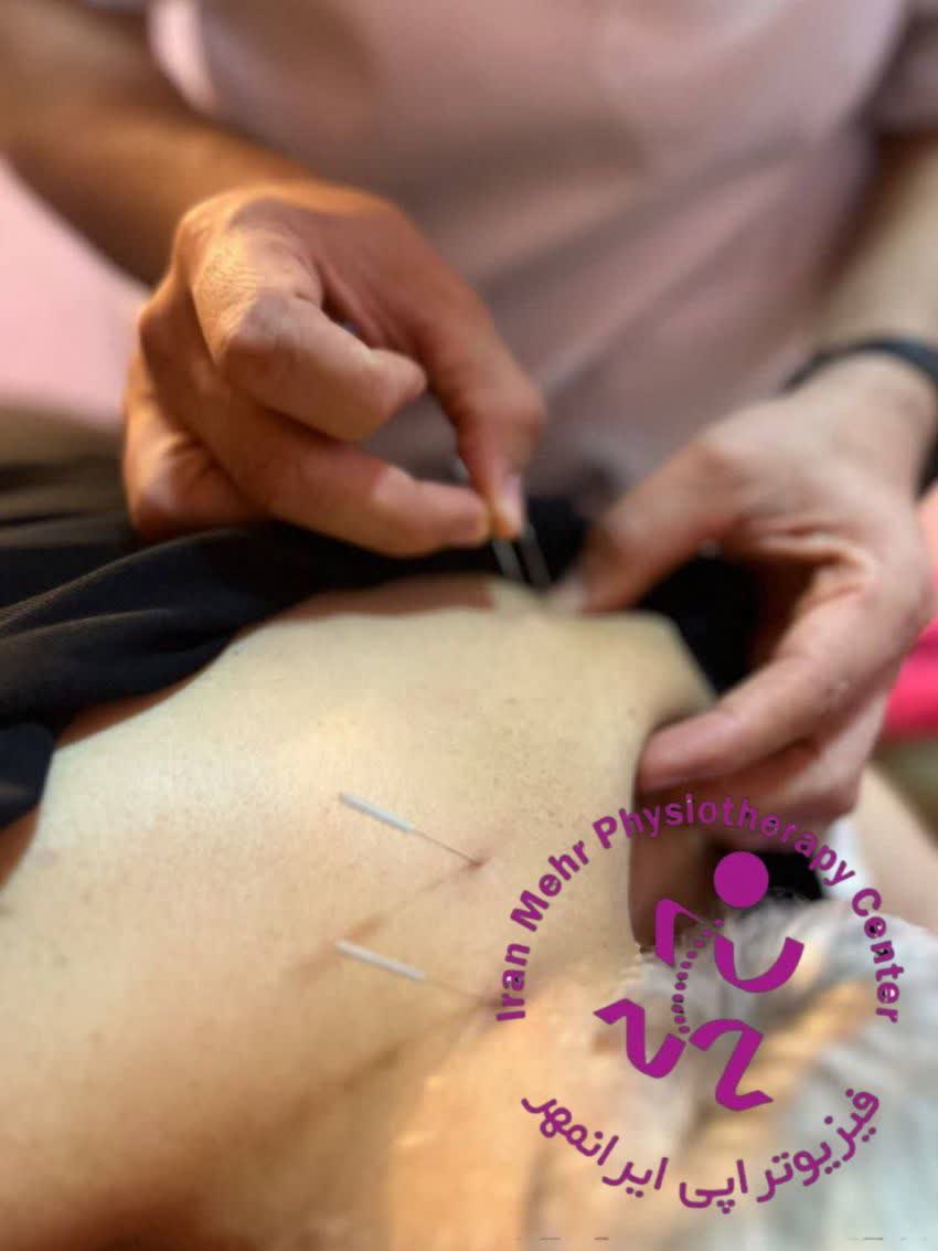 درای نیدلینگ