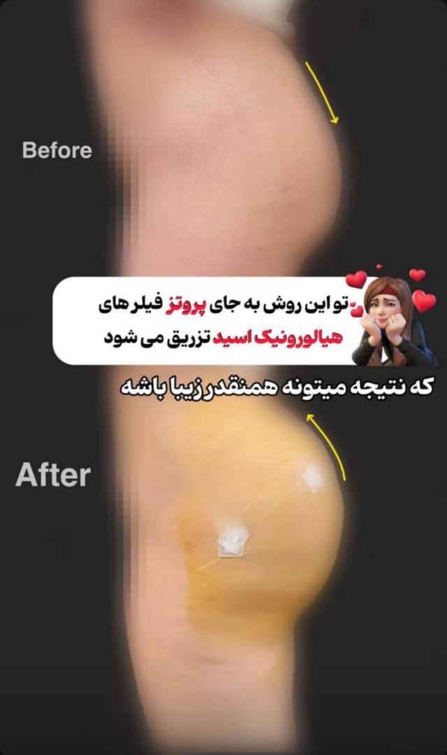 فیلرباسن تهران