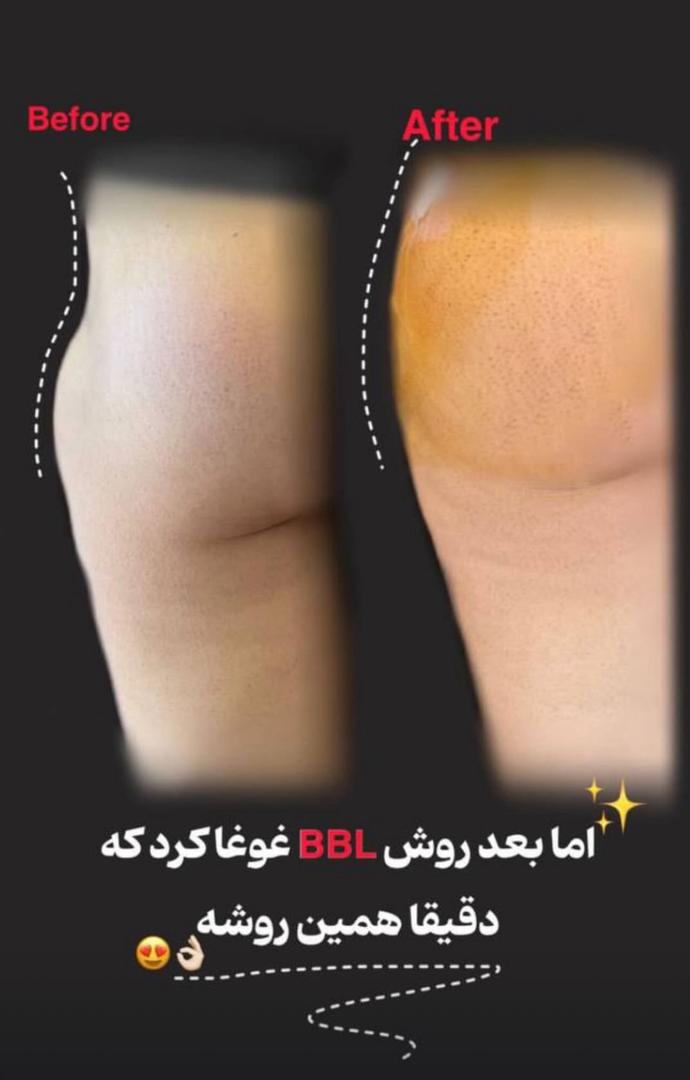 فیلرباسن تهران