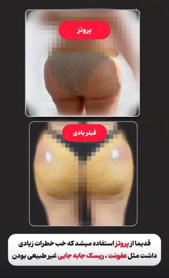 فیلرباسن تهران