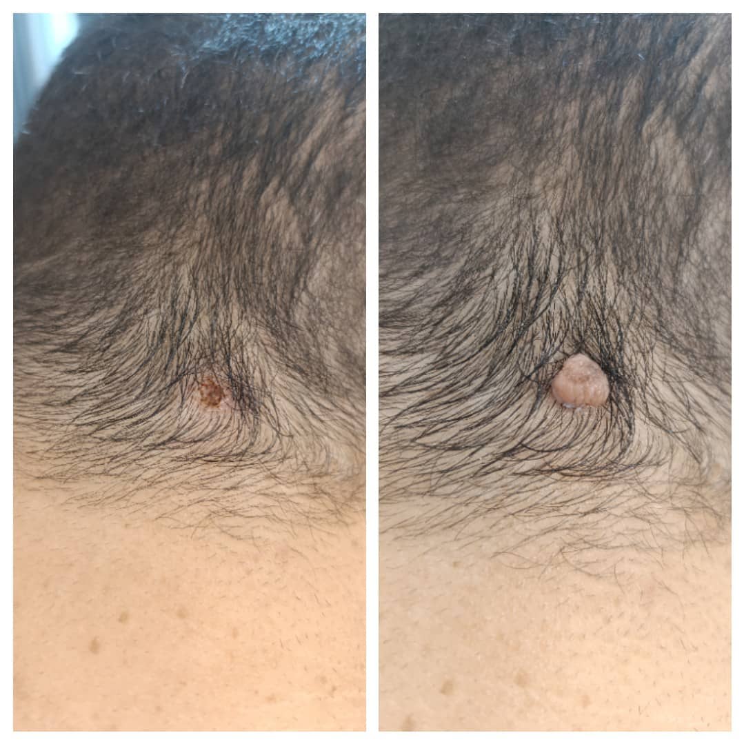 ریمو تتو با لیزرهشتگرد 