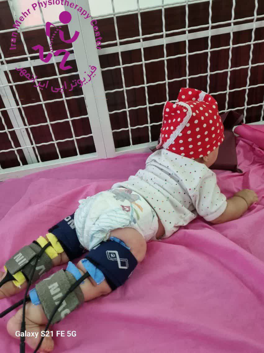 تقویت اندام های تحتانی بدنبال مننگومیلوسل