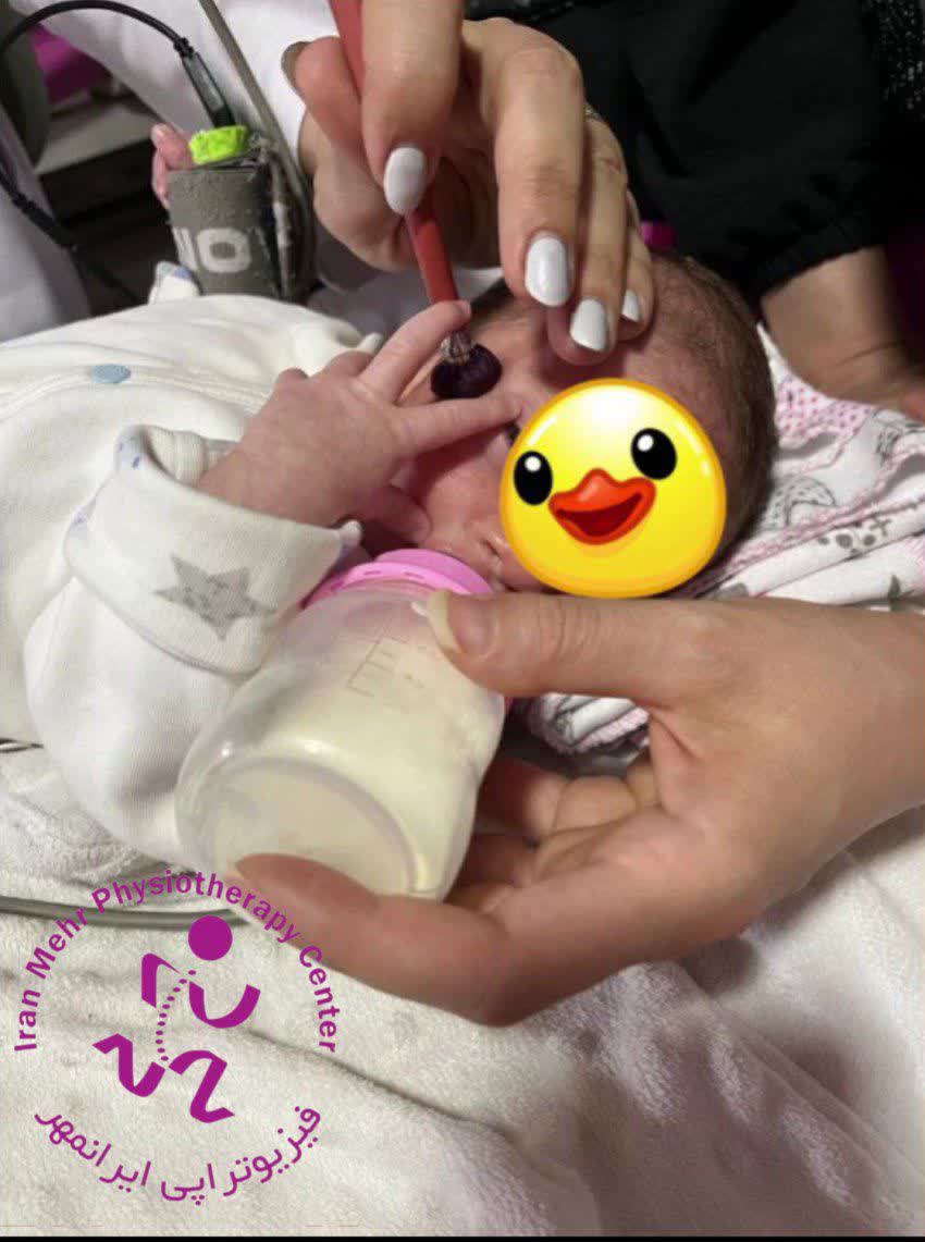 درمان فلج مادرزادی صورت نوزاد
