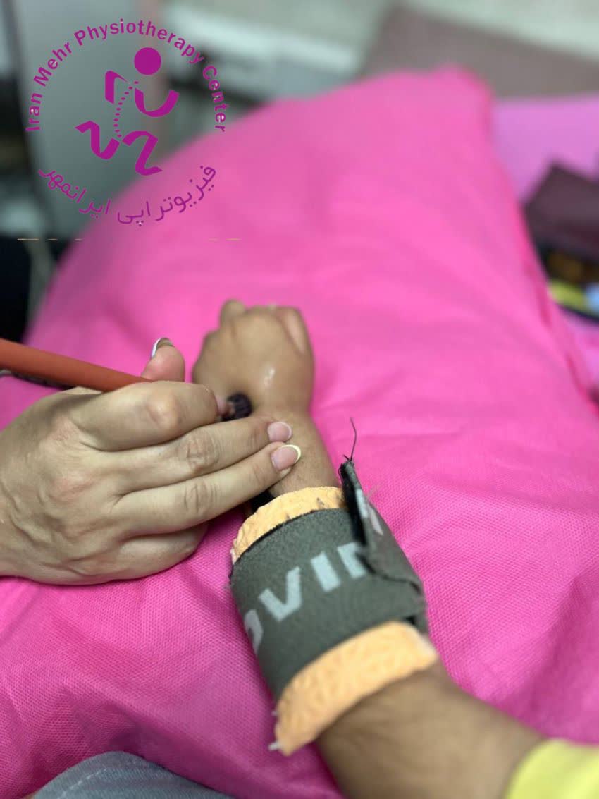 استفاده از الکترود قلمی در تحریک عضله بصورت نقطه ای