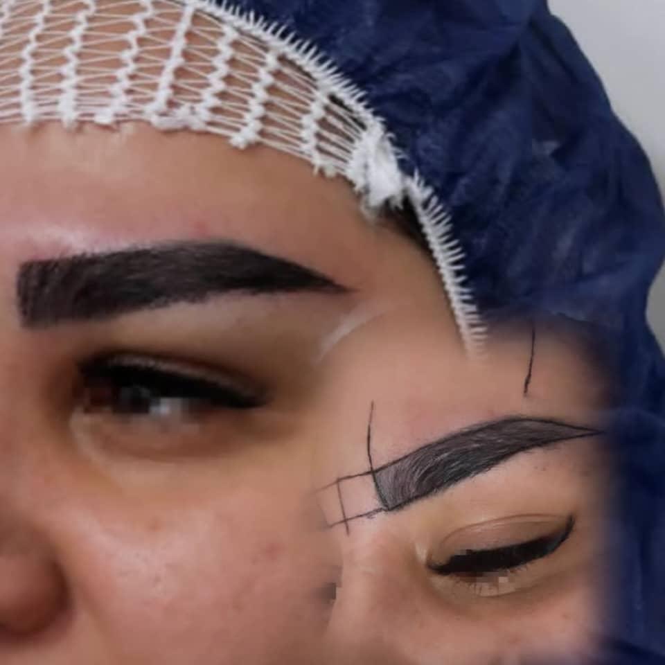 کاشت ابروبه روش جراحی