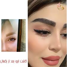 تروما یا آسیب به ناحیه کاشت