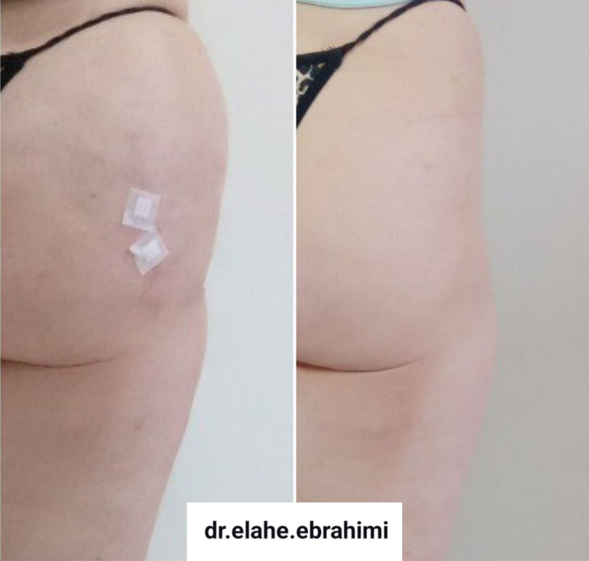 تزریق فیلر بادی در اصفهان دکتر زن 