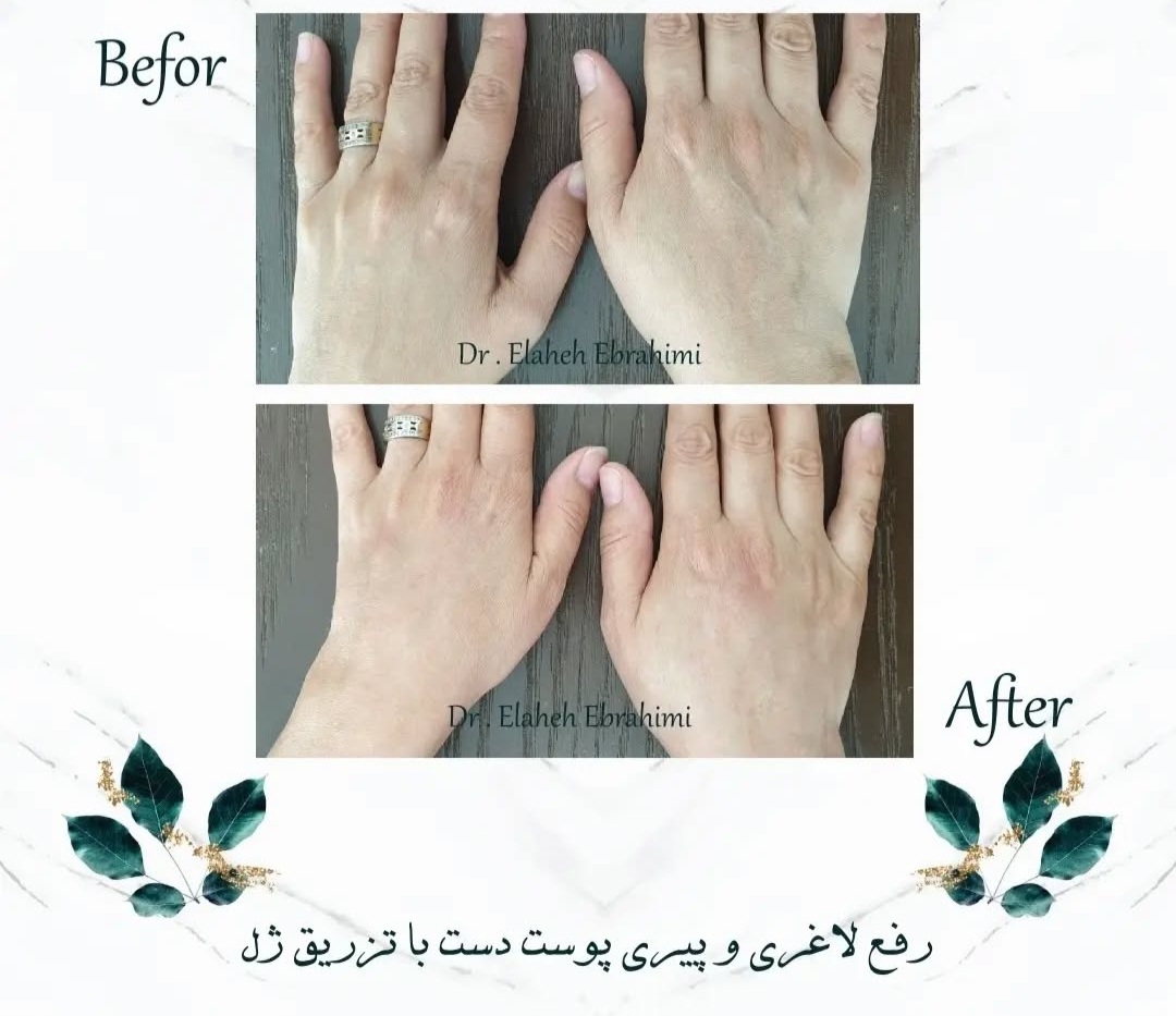 تزریق فیلر بادی در اصفهان دکتر زن 