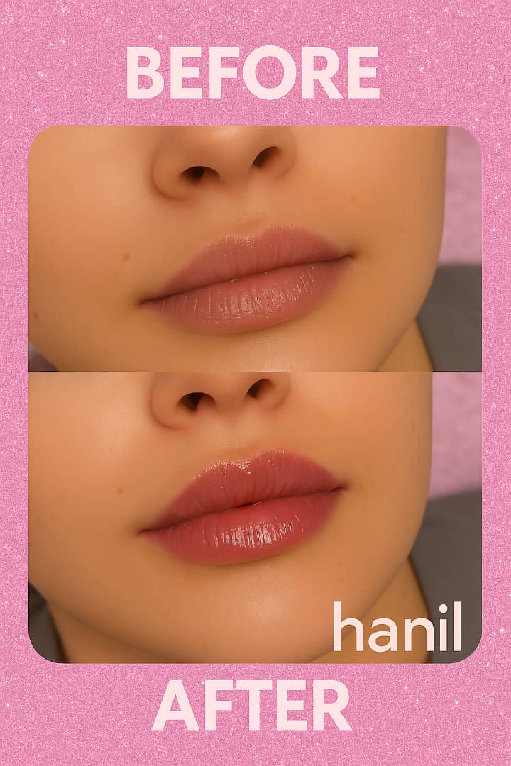 فیلر لب و تزریق ژل در نارمک