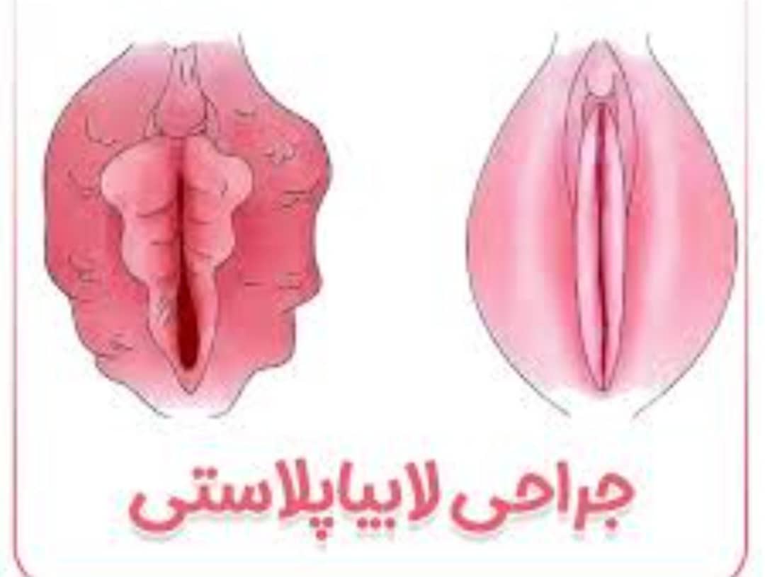 مرکز لابیاپلاستی بدون درد در خرم اباد
