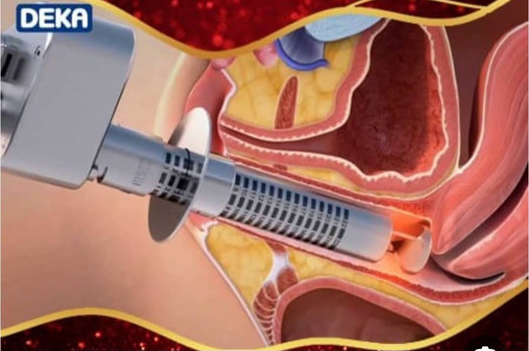 نوبت اینترنتی درمان زگیل تناسلی در خرم اباد