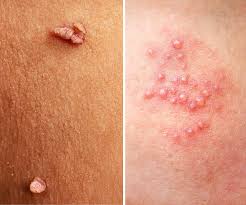 نوبت اینترنتی درمان زگیل تناسلی در خرم اباد