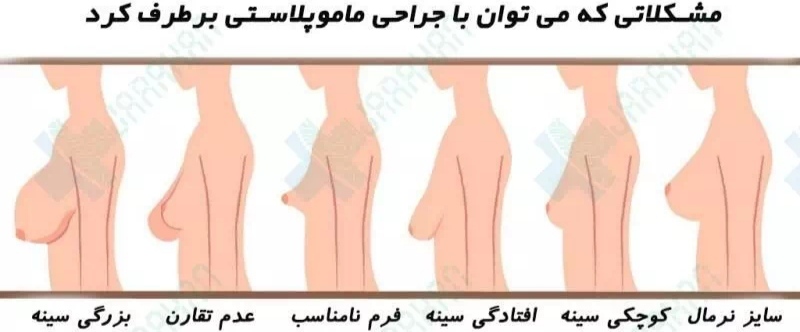 ماموپلاستی در زاهدان