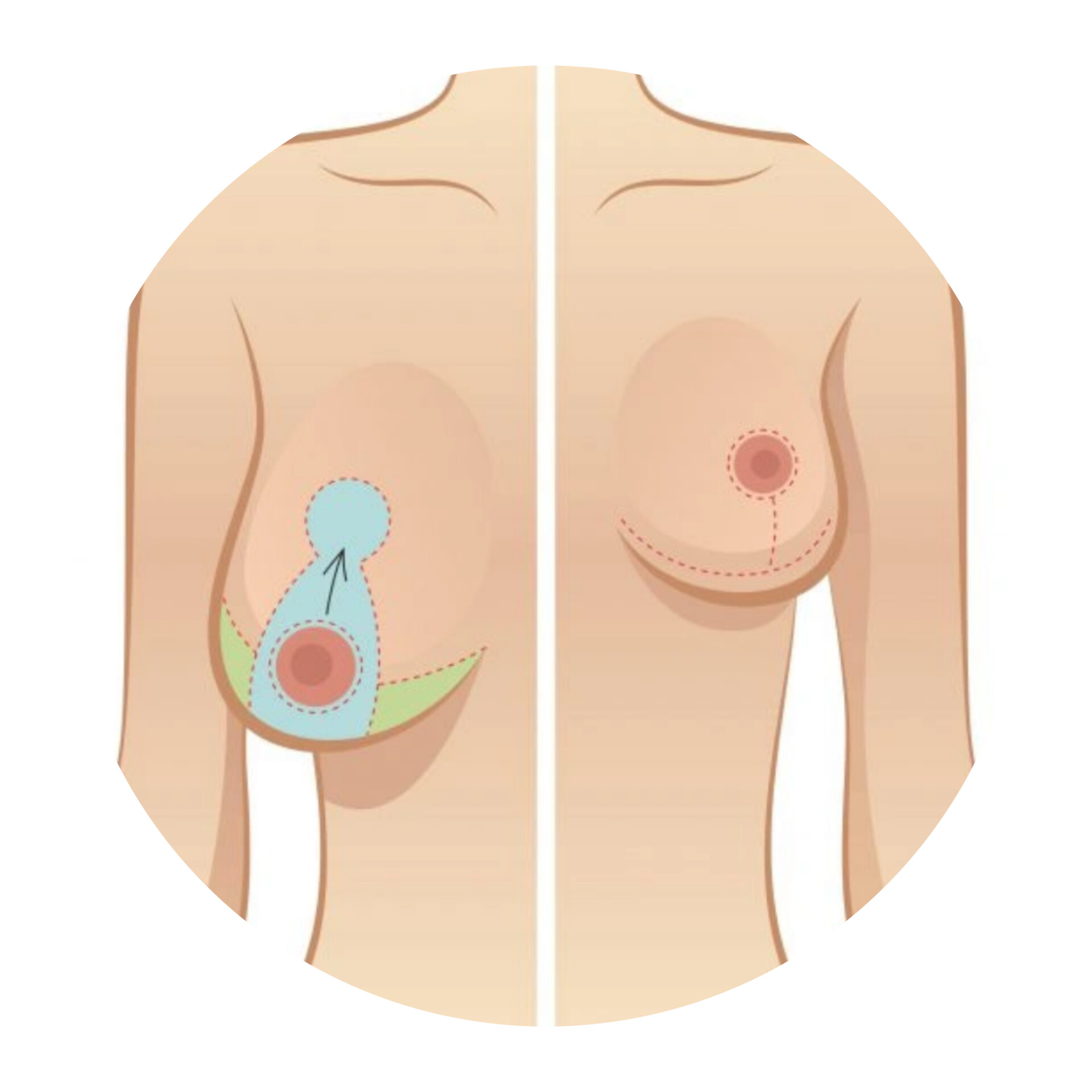 ماموپلاستی در زاهدان