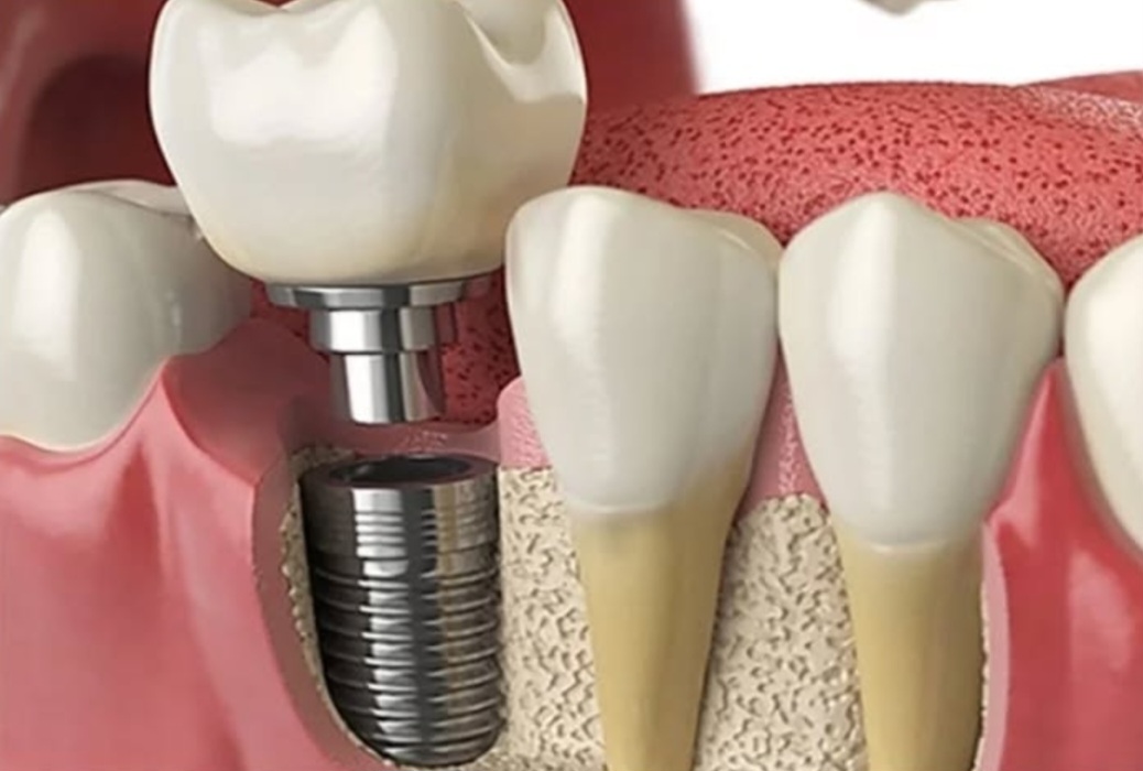 کاشت و جراحی ایمپلنت اقساطی در نجف اباد