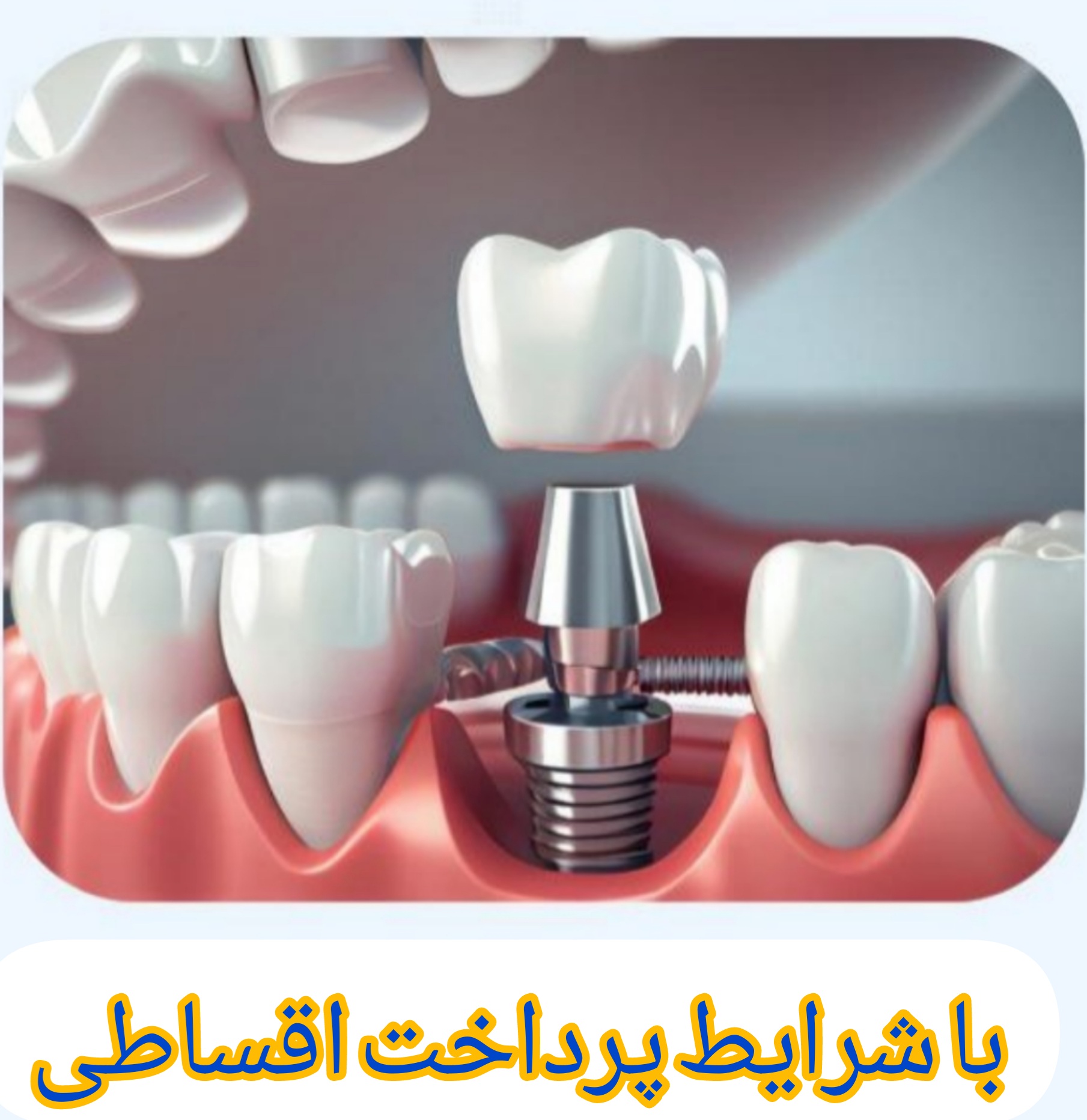 مرکز تخصصی ایمپلنت قسطی در فولادشهر