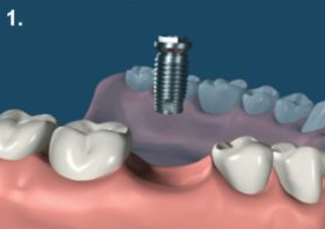 مرکز تخصصی ایمپلنت قسطی در فولادشهر