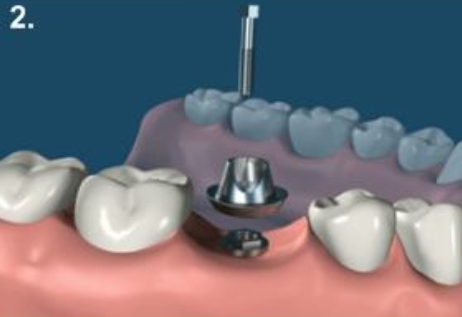 مرکز تخصصی ایمپلنت قسطی در فولادشهر