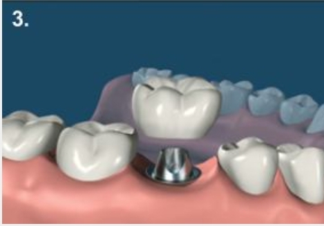 مرکز تخصصی ایمپلنت قسطی در فولادشهر