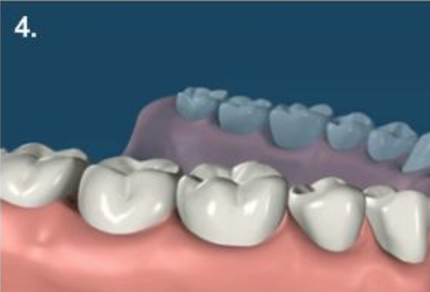 مرکز تخصصی ایمپلنت قسطی در فولادشهر