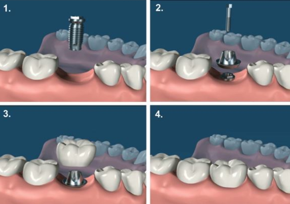 مرکز تخصصی ایمپلنت قسطی در فولادشهر